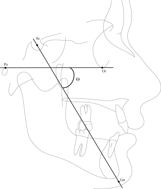 Rasterstereographical measurements (sagittal plane): (a) flèche